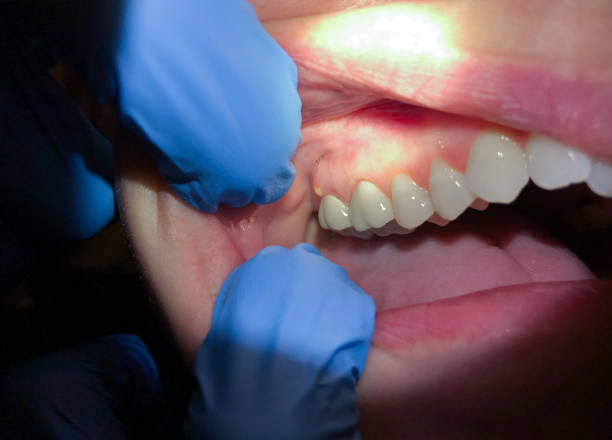 Best Emergency Tooth Extraction in Dry Ridge, KY